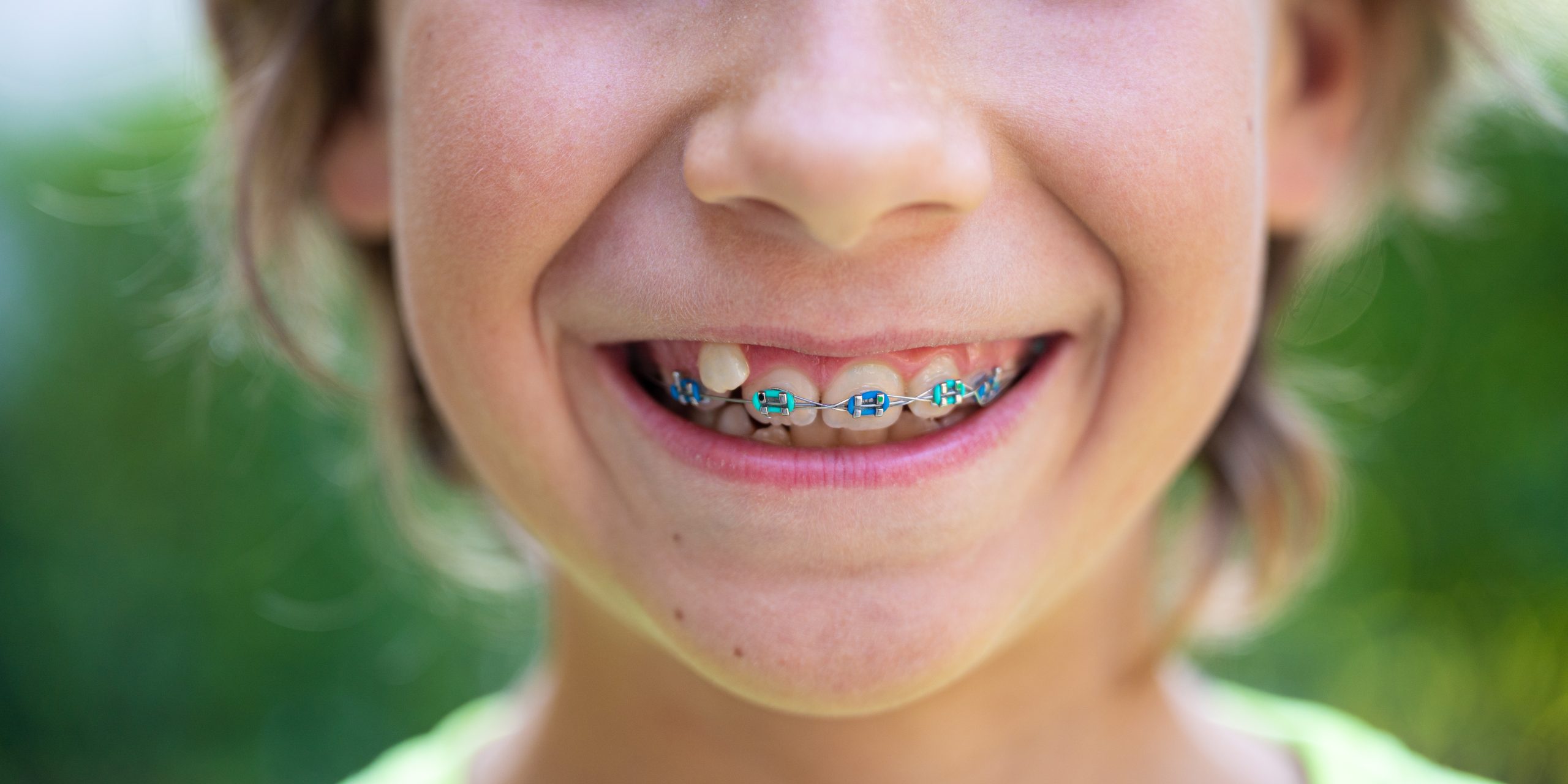 Closeup,View,Of,A,Child,With,Dental,Braces,Smiling.